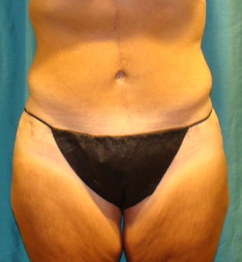 Tummy Tuck Before & After Gallery - Patient 89987992 - Image 4