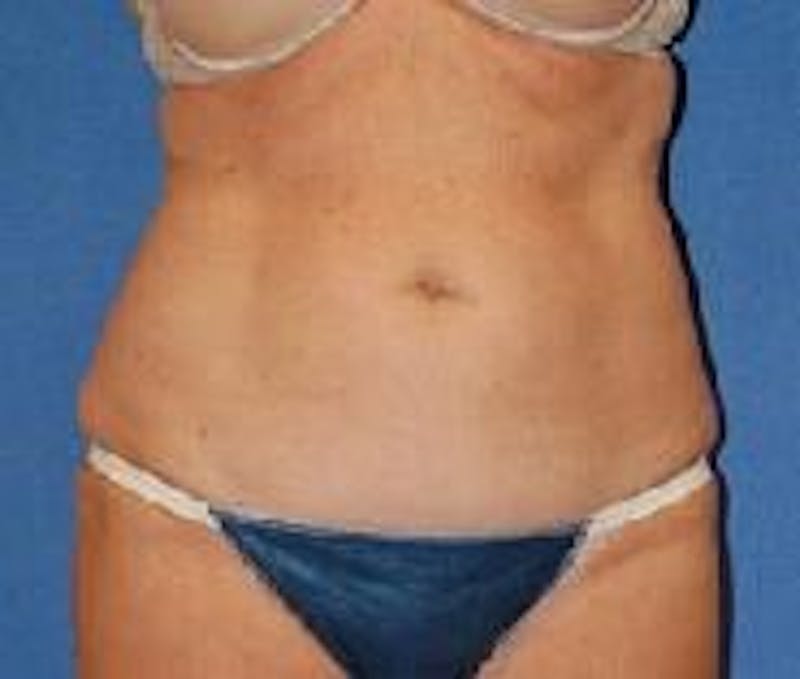 Tummy Tuck Before & After Gallery - Patient 89987993 - Image 1