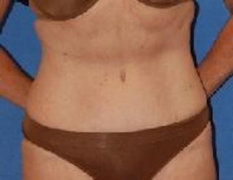 Tummy Tuck Before & After Gallery - Patient 89987993 - Image 2