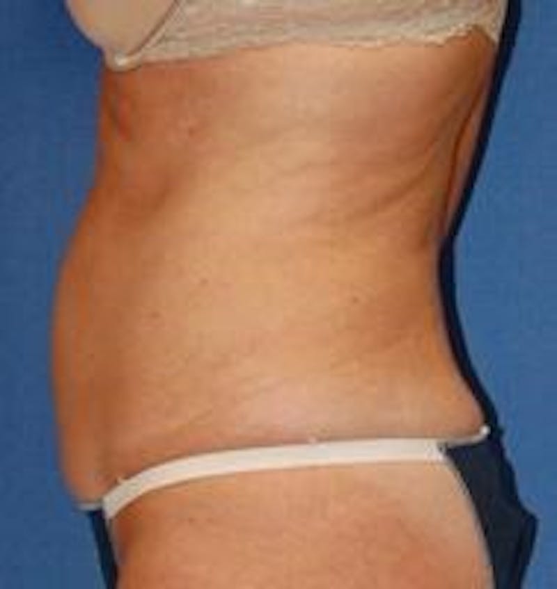 Tummy Tuck Before & After Gallery - Patient 89987993 - Image 3