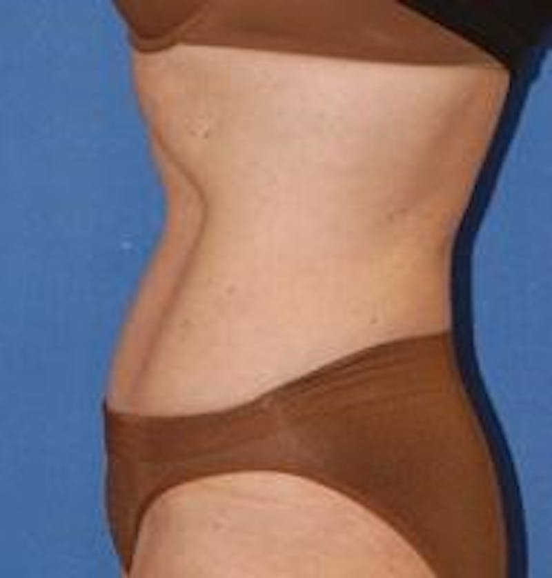 Tummy Tuck Before & After Gallery - Patient 89987993 - Image 4