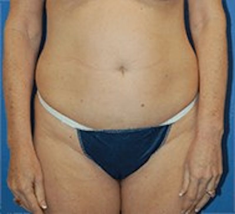 Tummy Tuck Before & After Gallery - Patient 89987995 - Image 1