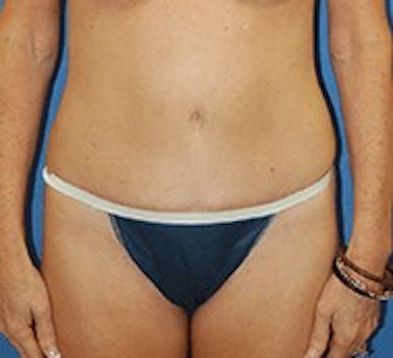 Tummy Tuck Before & After Gallery - Patient 89987995 - Image 2