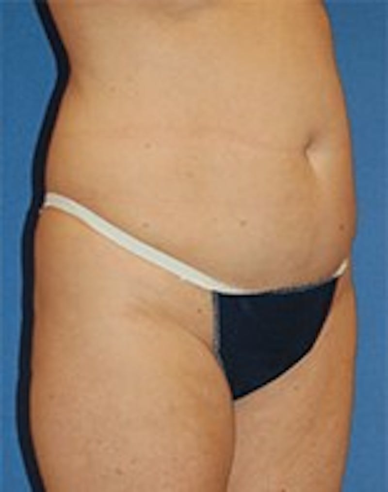 Tummy Tuck Before & After Gallery - Patient 89987995 - Image 3