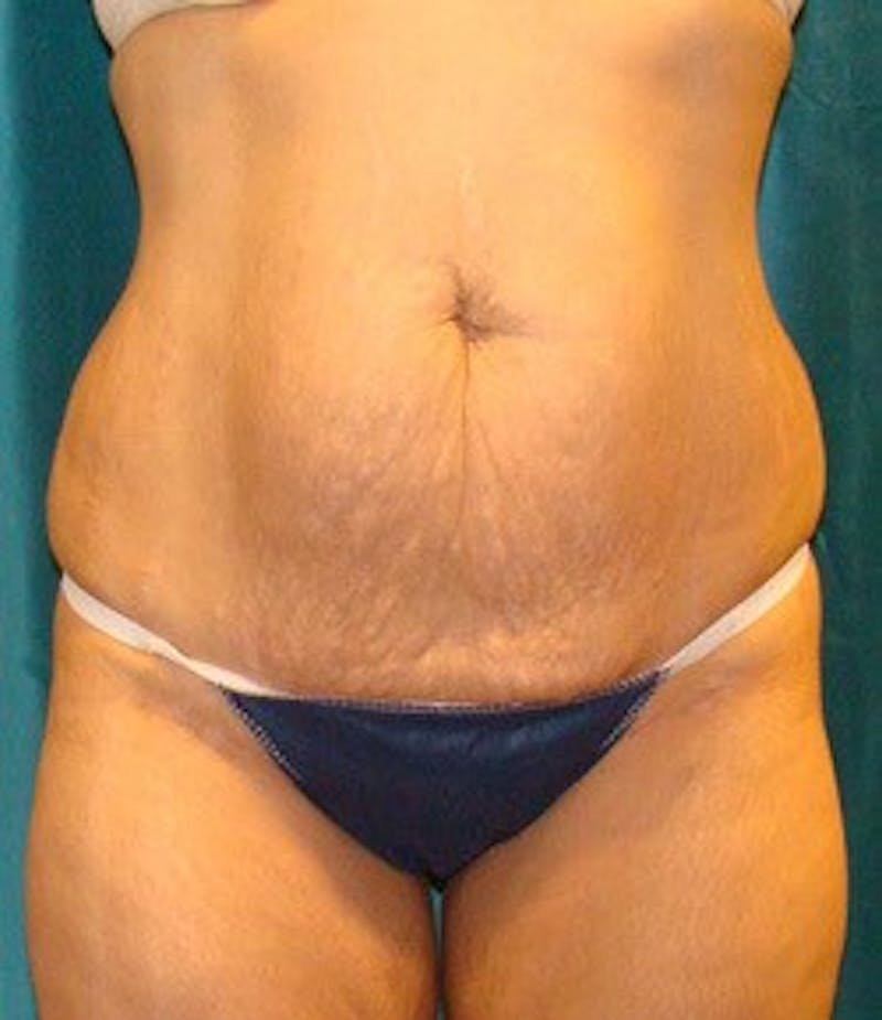 Tummy Tuck Before & After Gallery - Patient 89987996 - Image 1