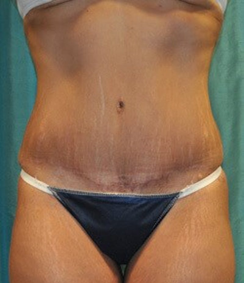 Tummy Tuck Before & After Gallery - Patient 89987996 - Image 2