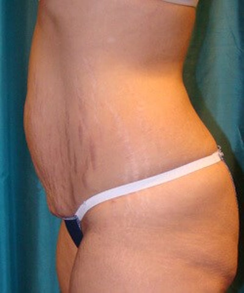 Tummy Tuck Before & After Gallery - Patient 89987996 - Image 3