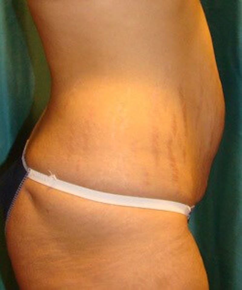 Tummy Tuck Before & After Gallery - Patient 89987996 - Image 5
