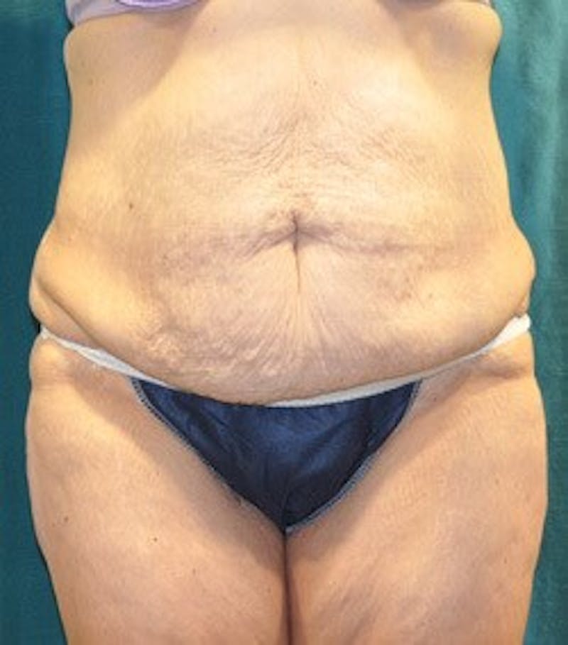 Tummy Tuck Before & After Gallery - Patient 89987997 - Image 1