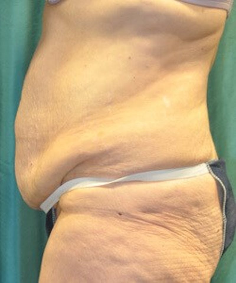 Tummy Tuck Before & After Gallery - Patient 89987997 - Image 3