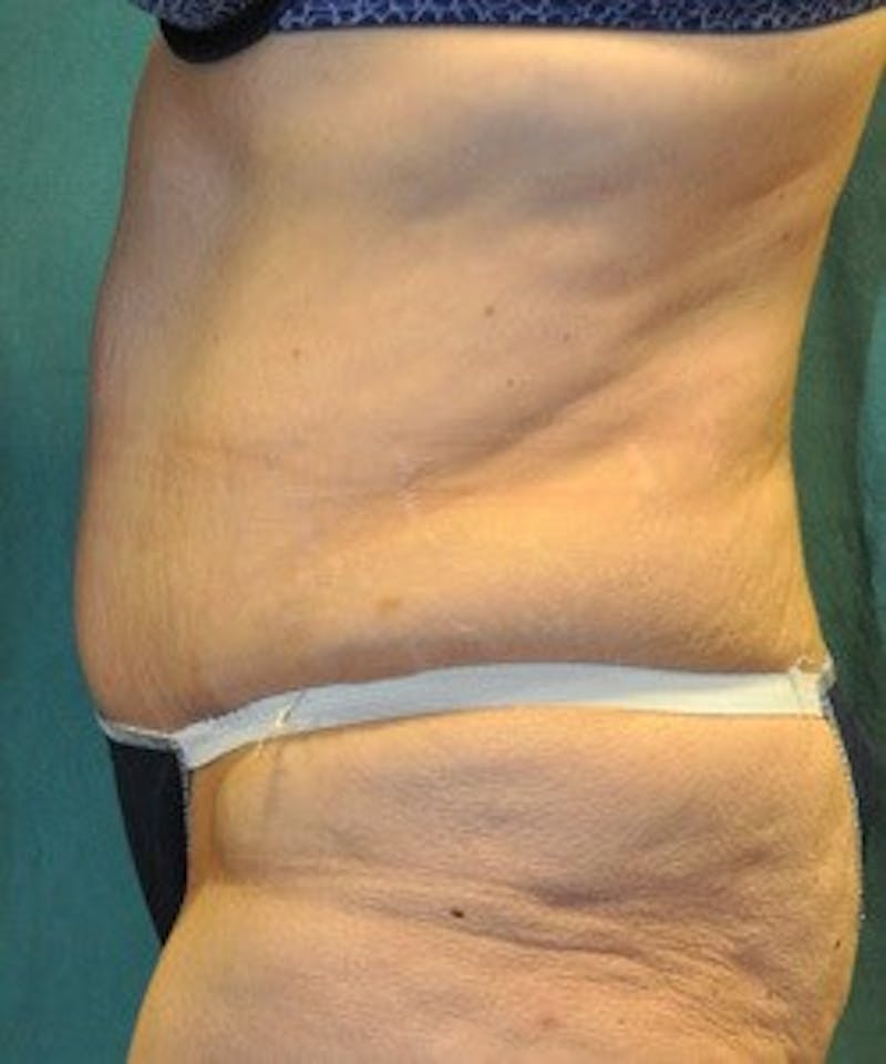 Tummy Tuck Before & After Gallery - Patient 89987997 - Image 4