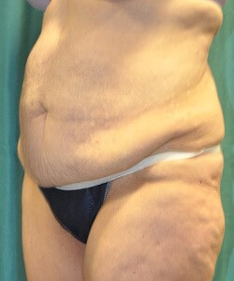 Tummy Tuck Before & After Gallery - Patient 89987997 - Image 5