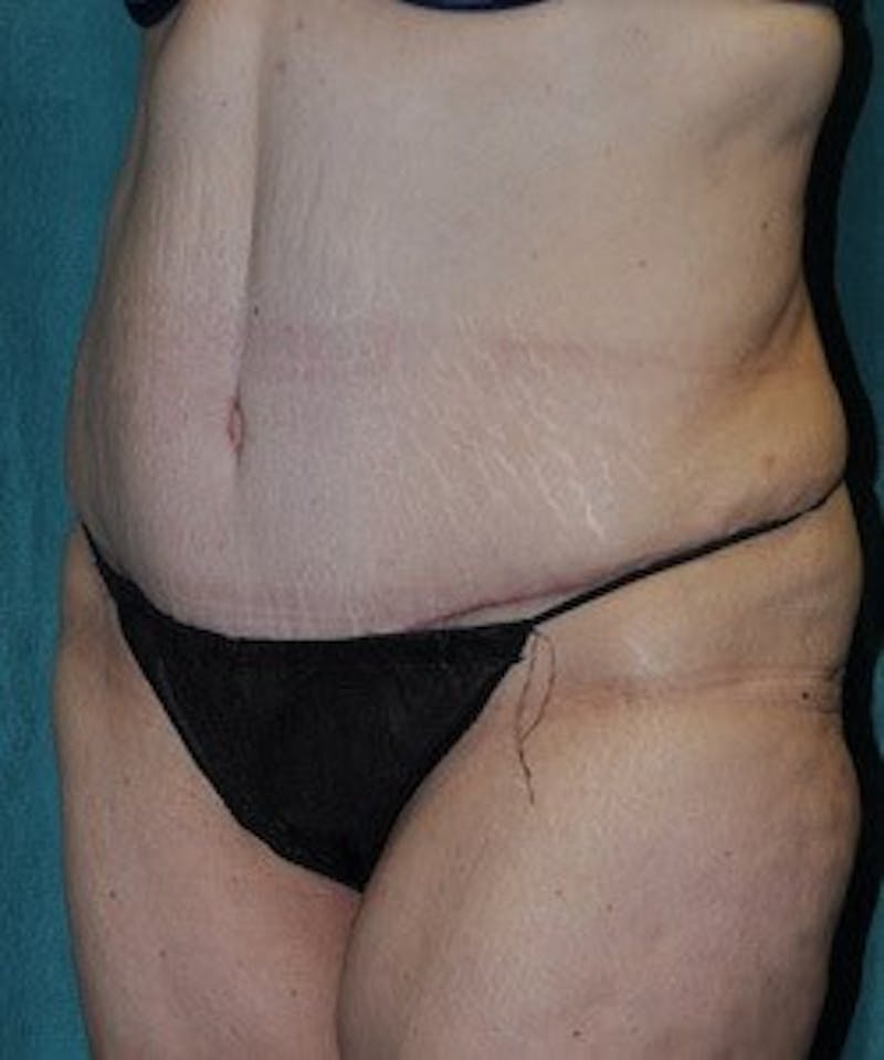 Tummy Tuck Before & After Gallery - Patient 89987997 - Image 6