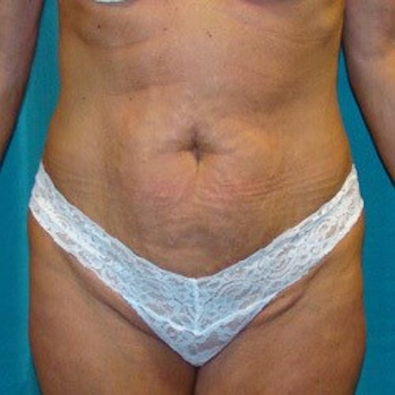 Tummy Tuck Before & After Gallery - Patient 89987998 - Image 1