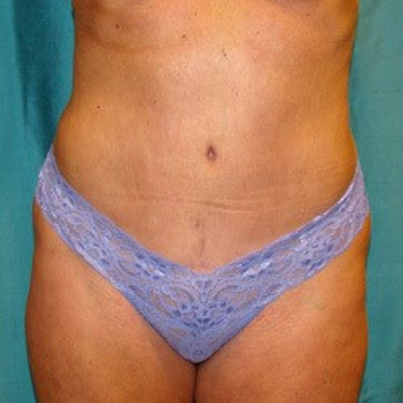Tummy Tuck Before & After Gallery - Patient 89987998 - Image 2