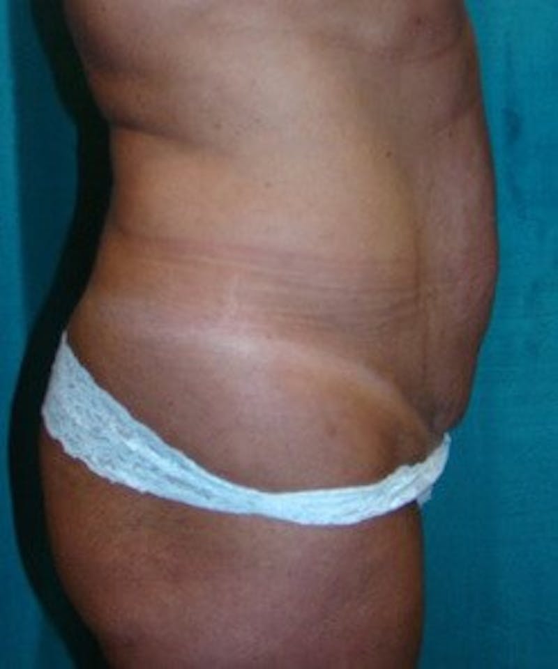 Tummy Tuck Before & After Gallery - Patient 89987998 - Image 3