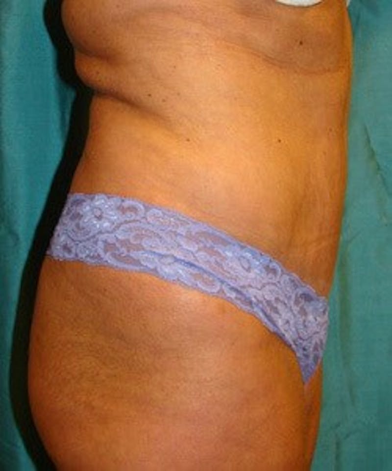 Tummy Tuck Before & After Gallery - Patient 89987998 - Image 4