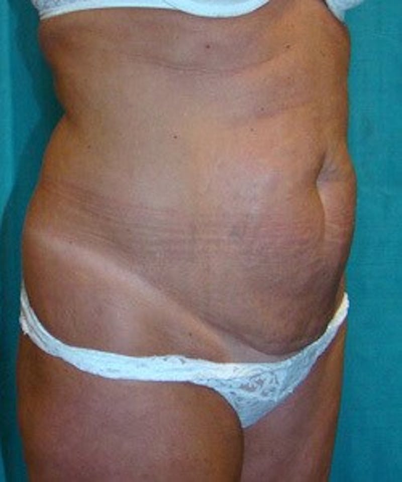 Tummy Tuck Before & After Gallery - Patient 89987998 - Image 5