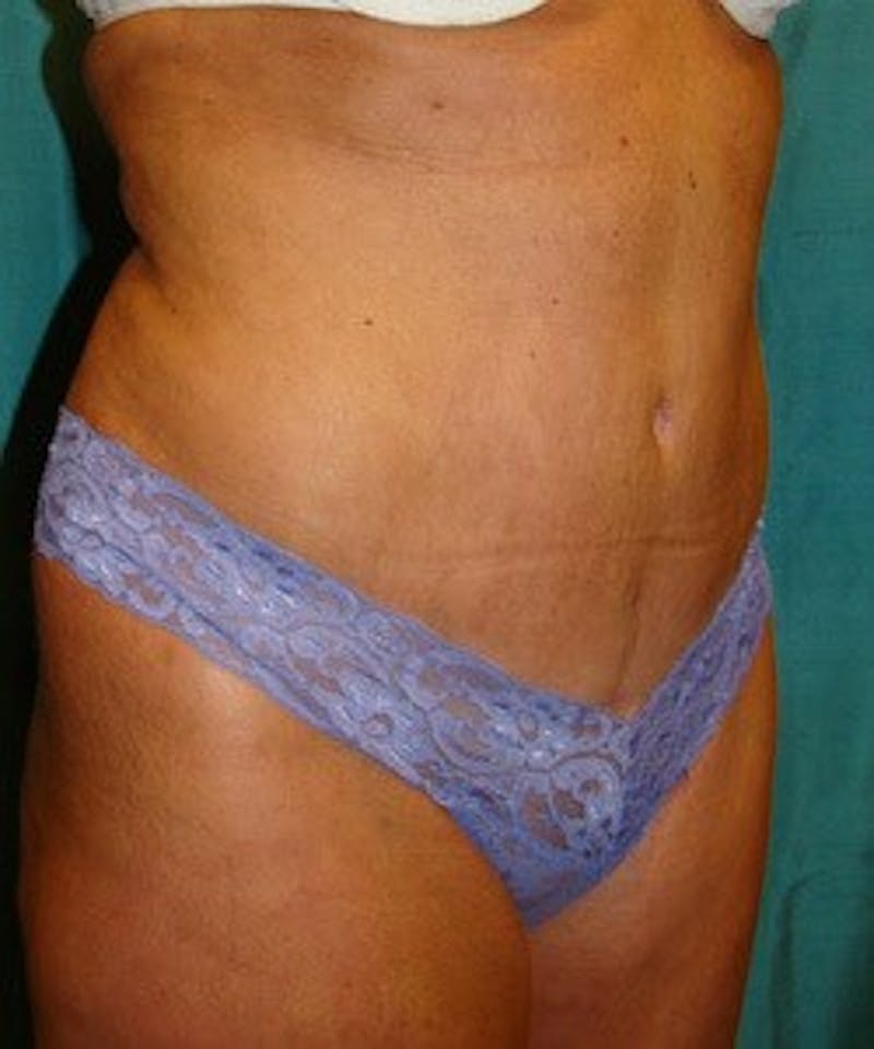 Tummy Tuck Before & After Gallery - Patient 89987998 - Image 6