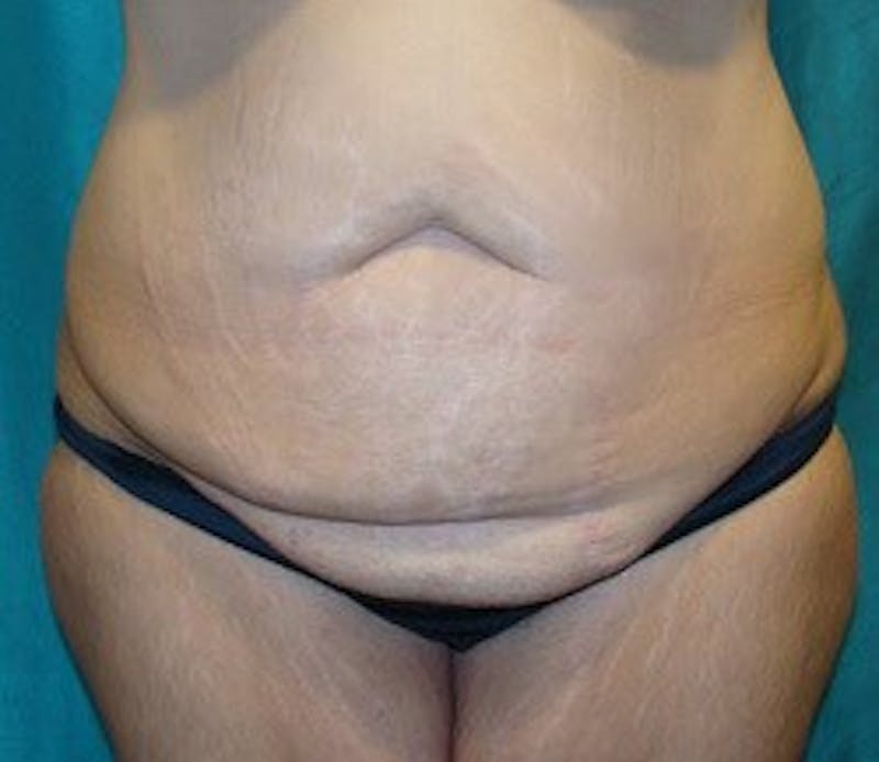 Tummy Tuck Before & After Gallery - Patient 89987999 - Image 1