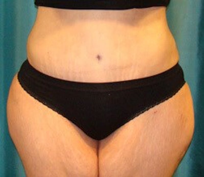 Tummy Tuck Before & After Gallery - Patient 89987999 - Image 2
