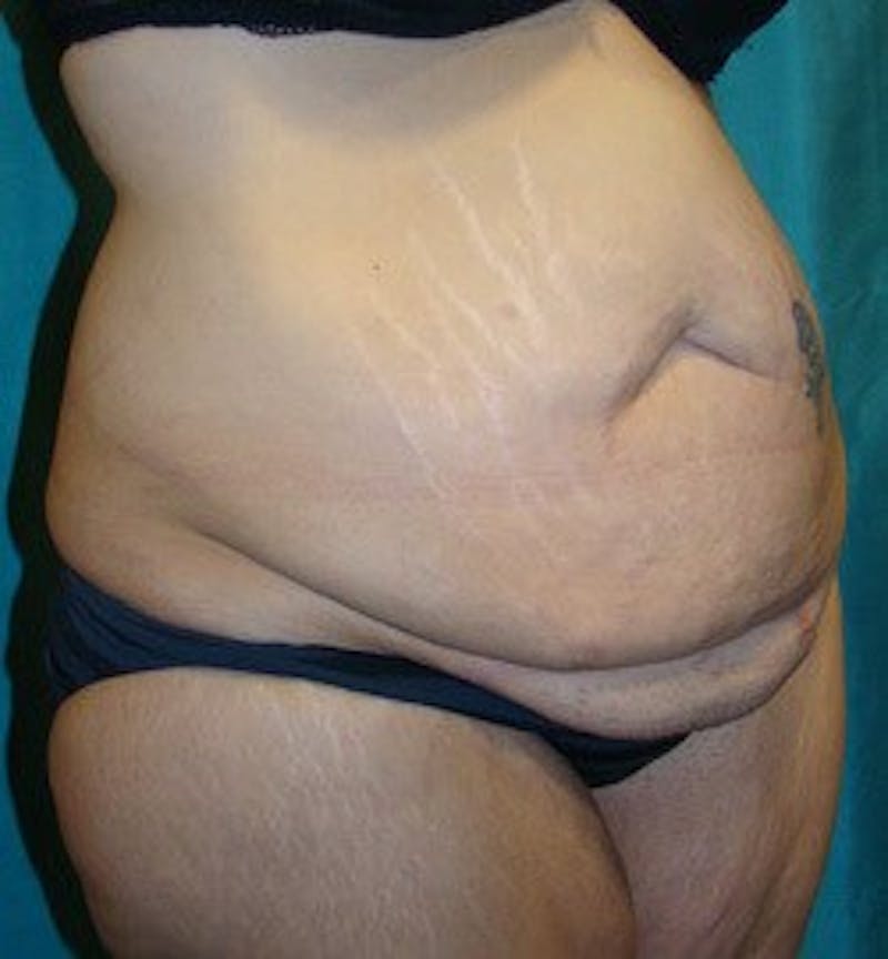 Tummy Tuck Before & After Gallery - Patient 89987999 - Image 3