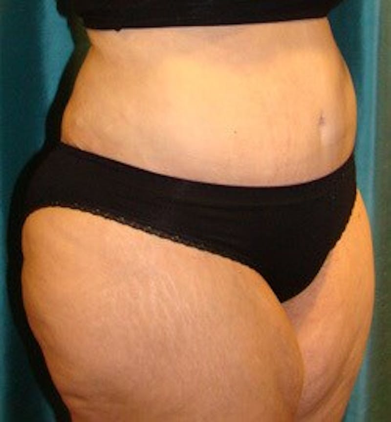 Tummy Tuck Before & After Gallery - Patient 89987999 - Image 4
