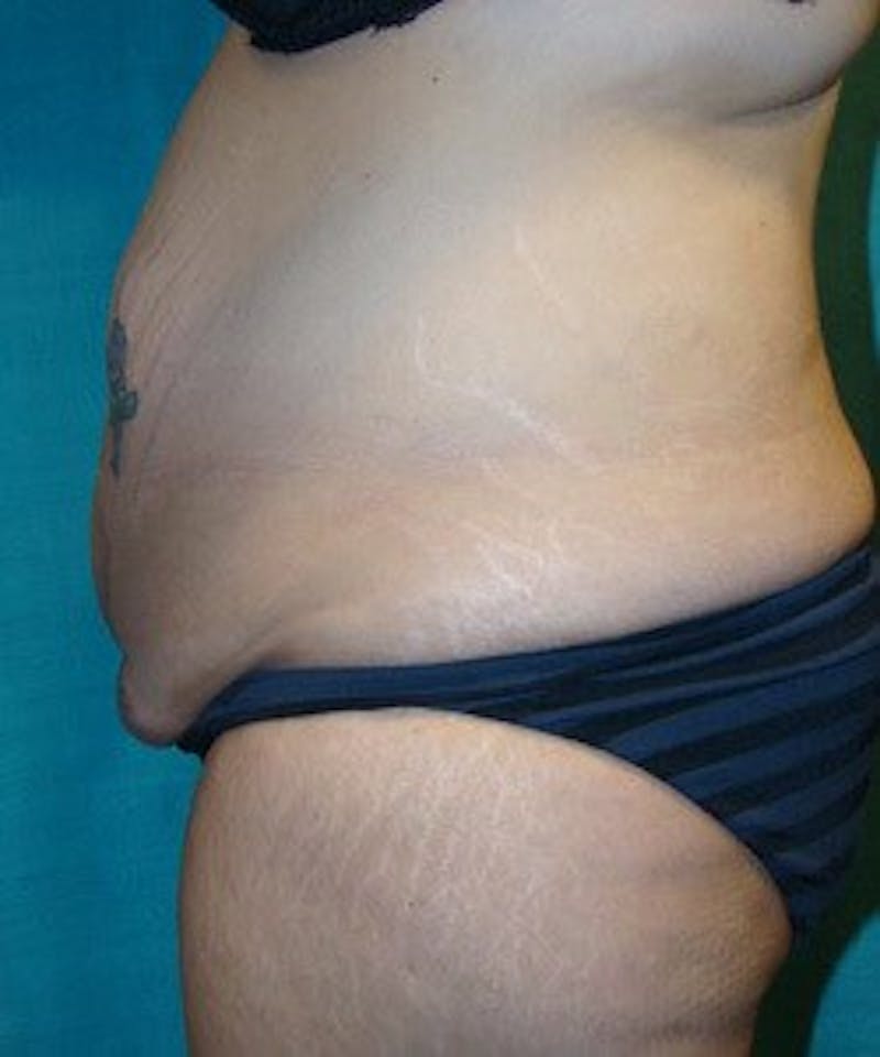 Tummy Tuck Before & After Gallery - Patient 89987999 - Image 5