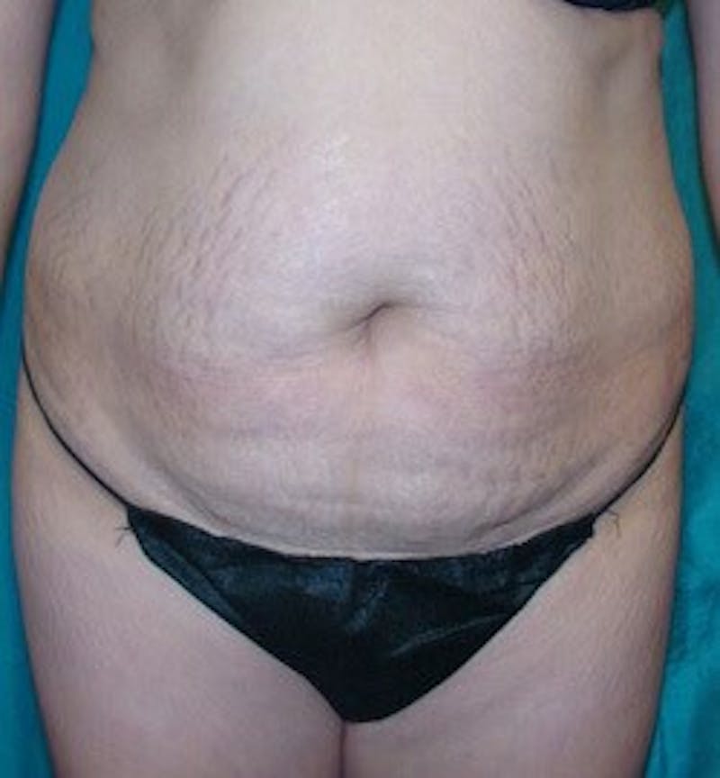 Tummy Tuck Before & After Gallery - Patient 89988000 - Image 1