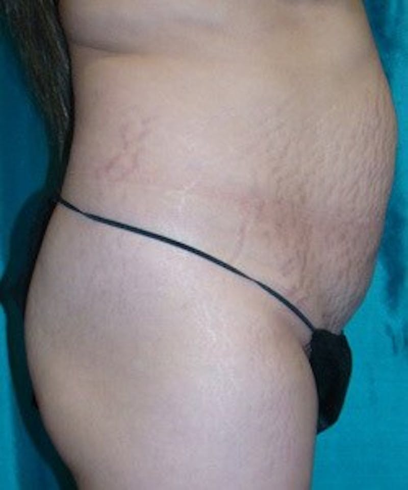 Tummy Tuck Before & After Gallery - Patient 89988000 - Image 3