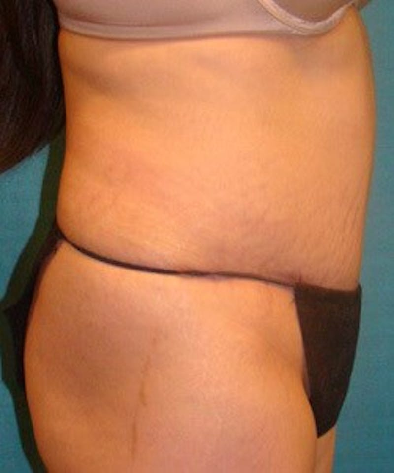 Tummy Tuck Before & After Gallery - Patient 89988000 - Image 4
