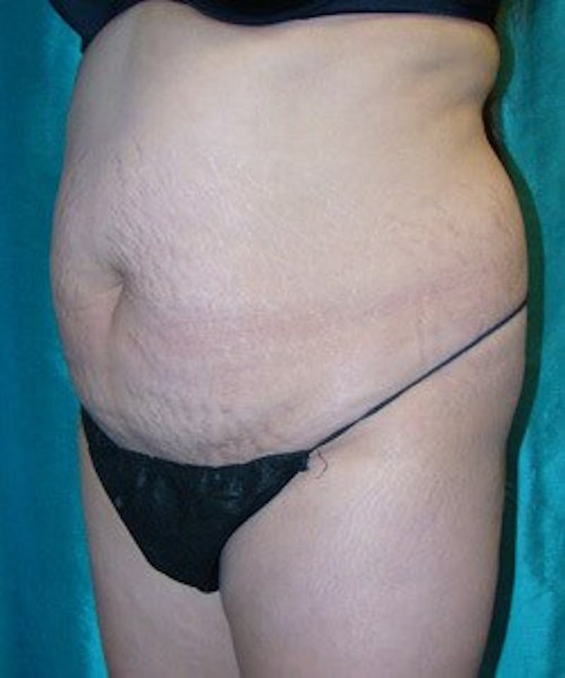 Tummy Tuck Before & After Gallery - Patient 89988000 - Image 5