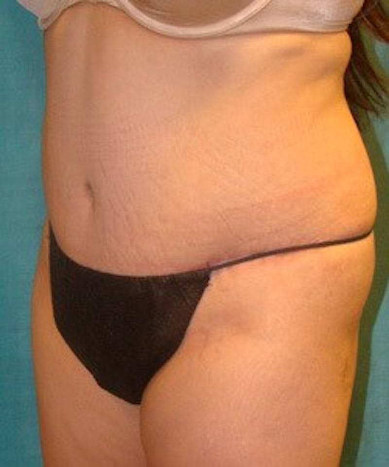 Tummy Tuck Before & After Gallery - Patient 89988000 - Image 6