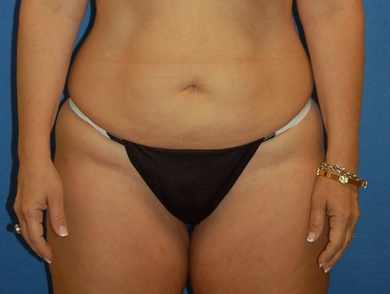 Tummy Tuck Before & After Gallery - Patient 89988135 - Image 1