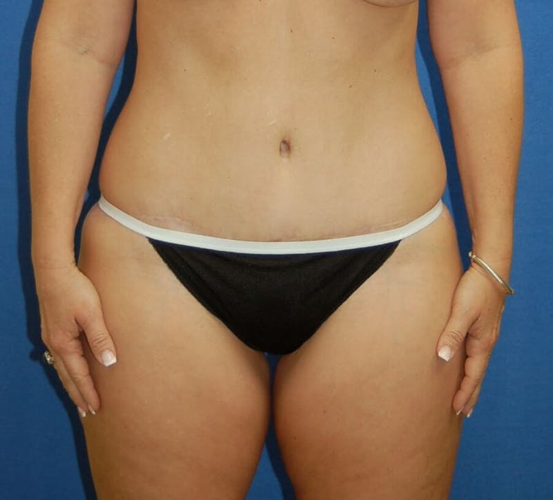 Tummy Tuck Before & After Gallery - Patient 89988135 - Image 2