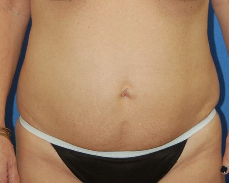 Tummy Tuck Before & After Gallery - Patient 89988138 - Image 1