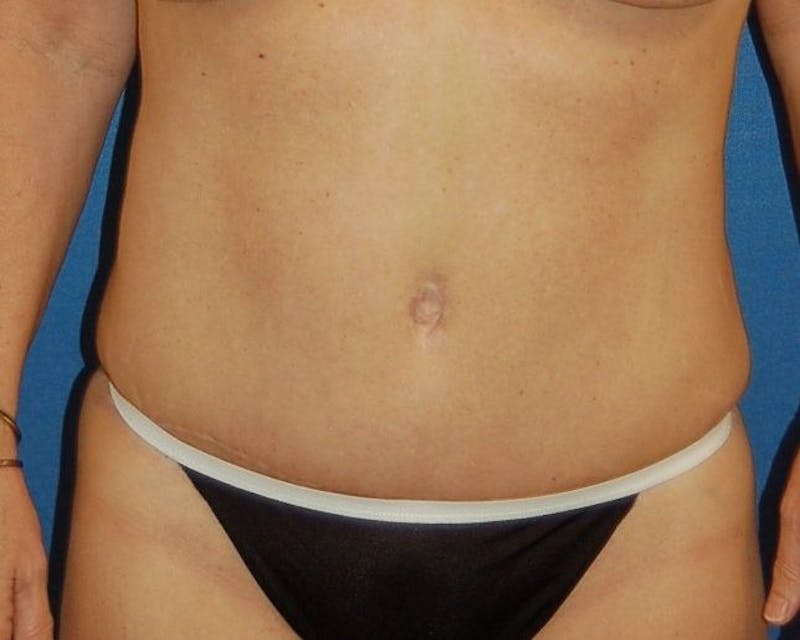 Tummy Tuck Before & After Gallery - Patient 89988138 - Image 2