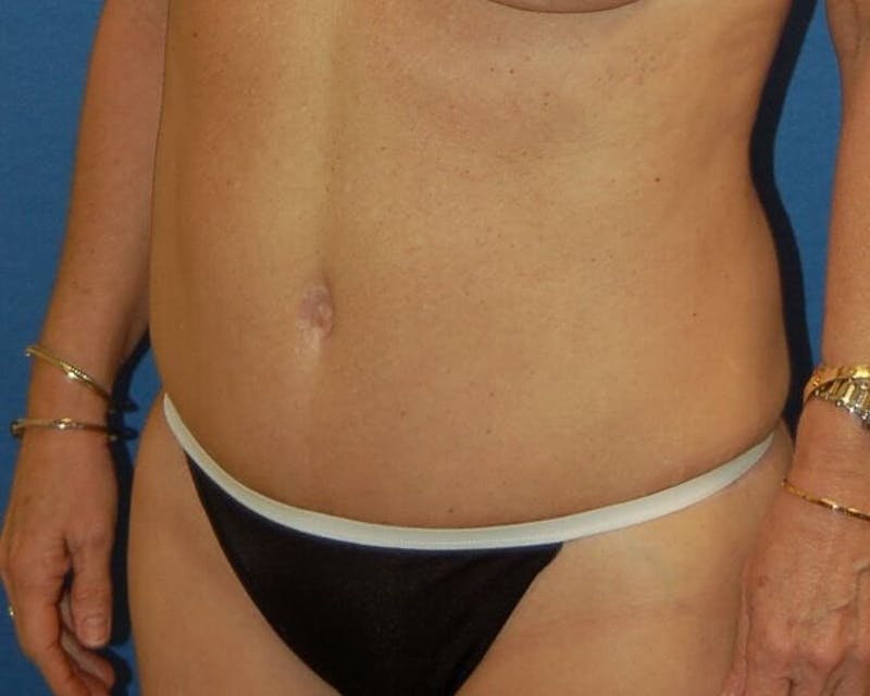 Tummy Tuck Before & After Gallery - Patient 89988138 - Image 4