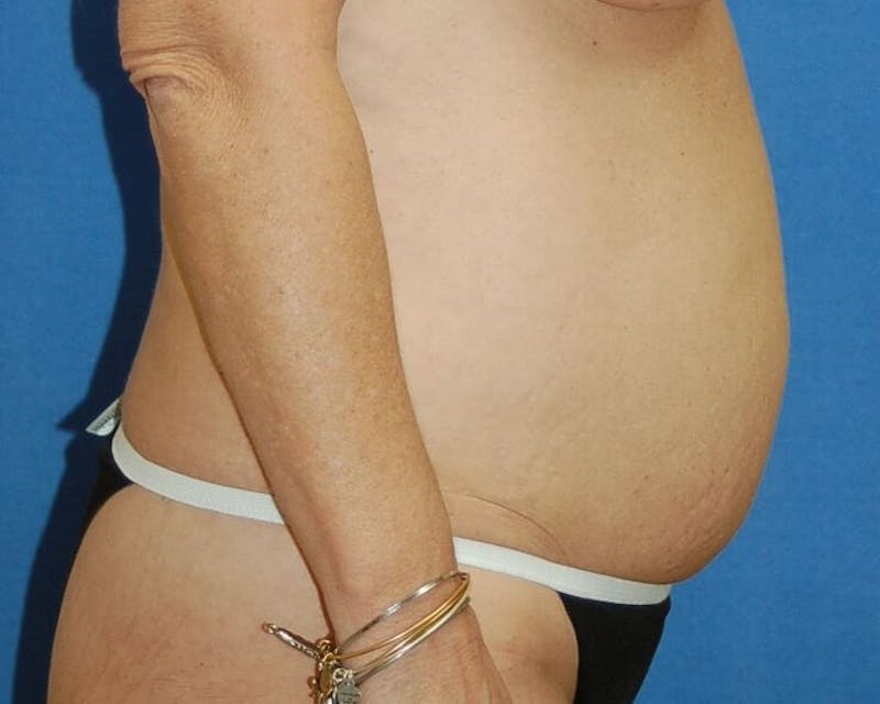 Tummy Tuck Before & After Gallery - Patient 89988138 - Image 5