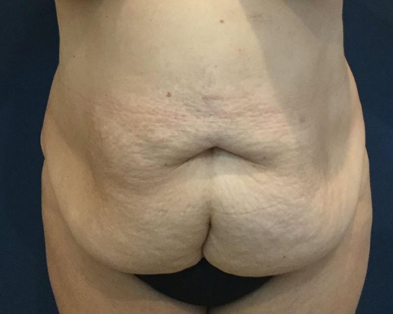 Tummy Tuck Before & After Gallery - Patient 89988139 - Image 1
