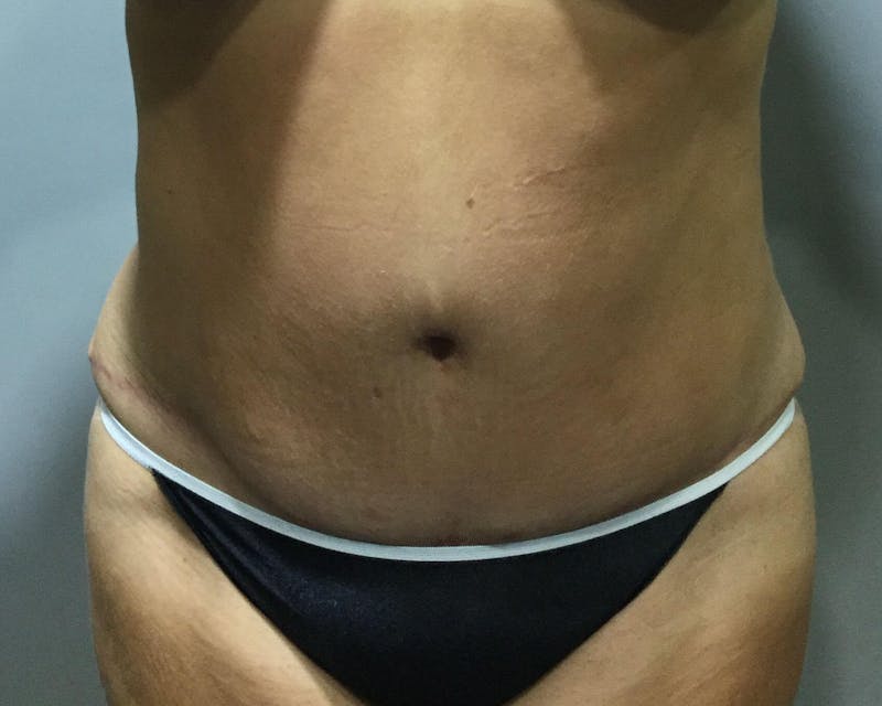 Tummy Tuck Before & After Gallery - Patient 89988139 - Image 2
