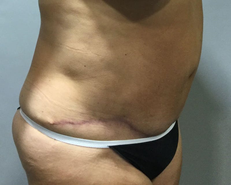 Tummy Tuck Before & After Gallery - Patient 89988139 - Image 4