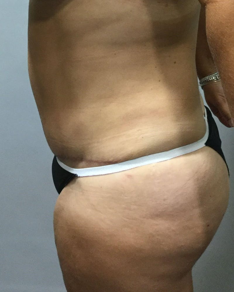 Tummy Tuck Before & After Gallery - Patient 89988139 - Image 6