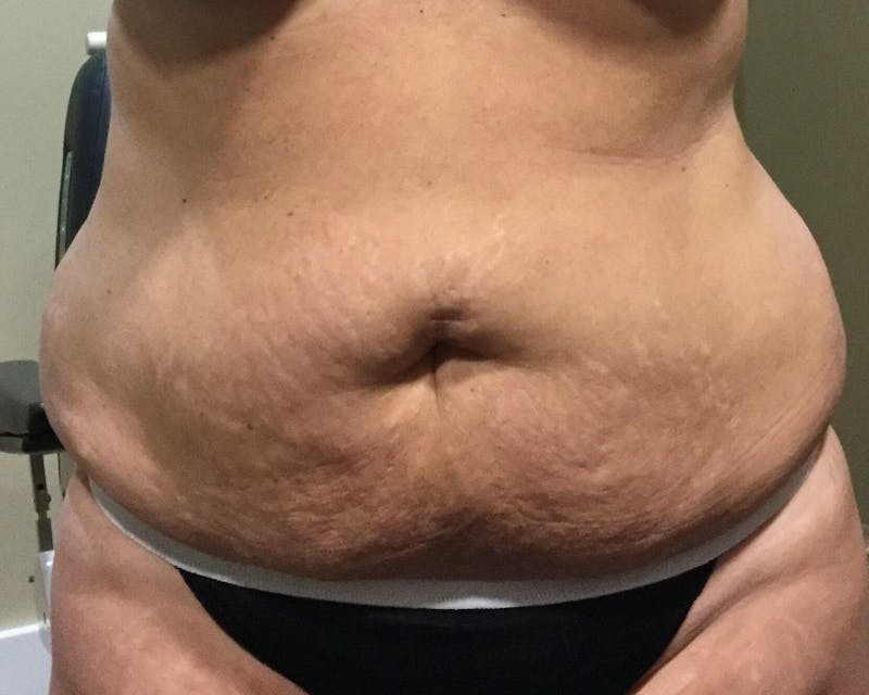 Tummy Tuck Before & After Gallery - Patient 89988143 - Image 1
