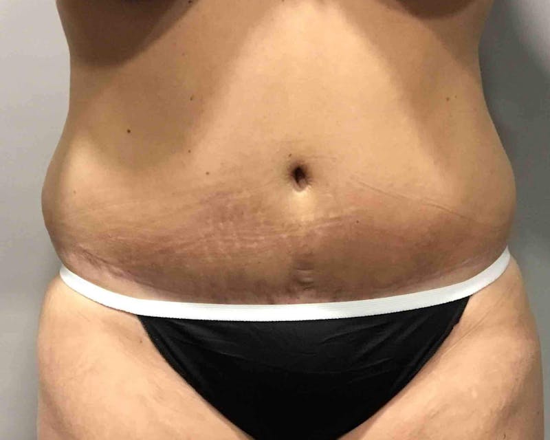 Tummy Tuck Before & After Gallery - Patient 89988143 - Image 2