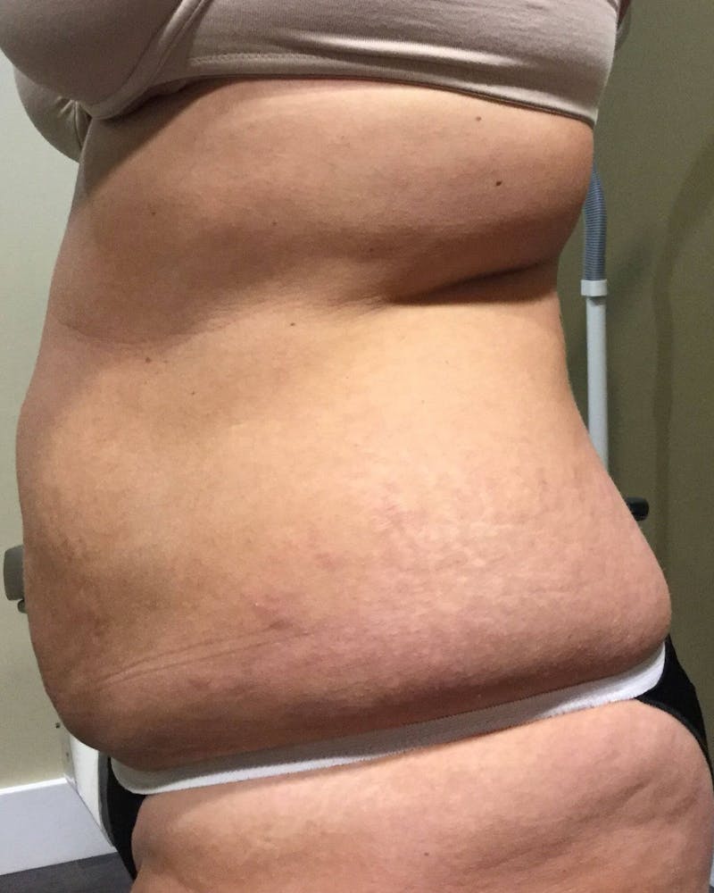 Tummy Tuck Before & After Gallery - Patient 89988143 - Image 3