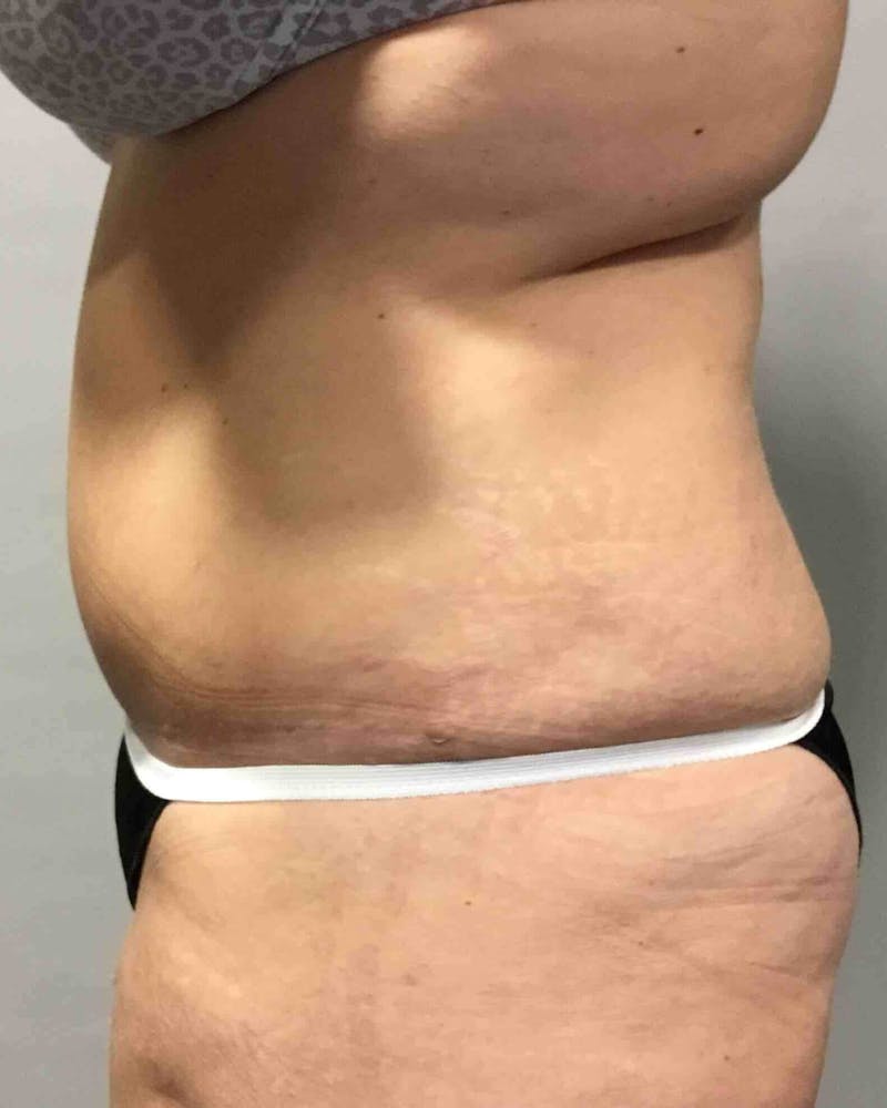 Tummy Tuck Before & After Gallery - Patient 89988143 - Image 4
