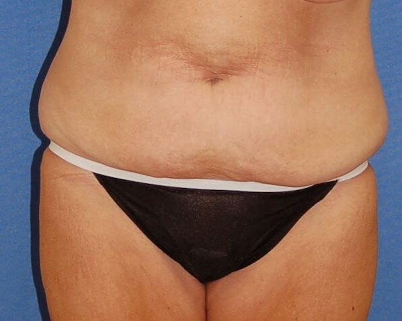 Tummy Tuck Before & After Gallery - Patient 89988144 - Image 1
