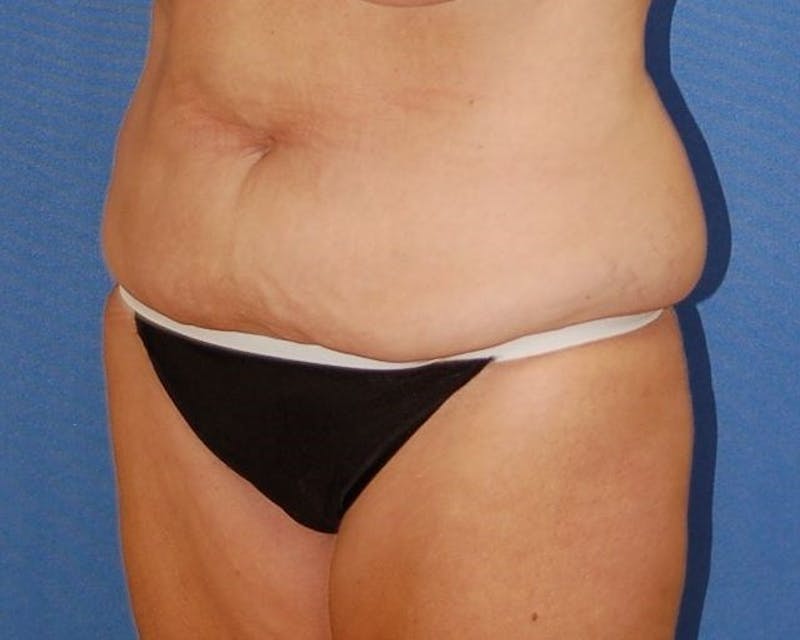Tummy Tuck Before & After Gallery - Patient 89988144 - Image 3