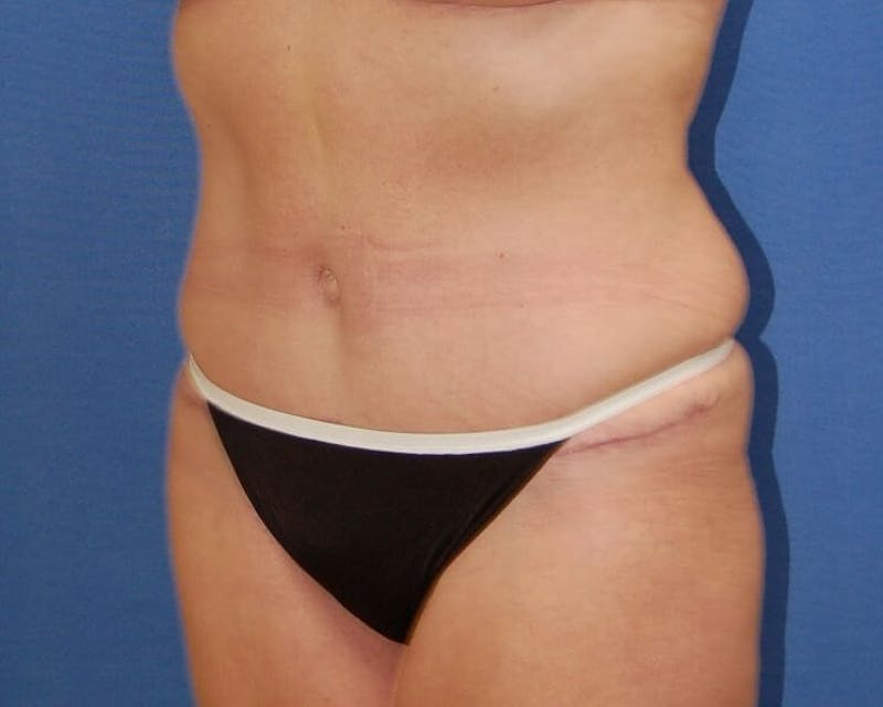 Tummy Tuck Before & After Gallery - Patient 89988144 - Image 4